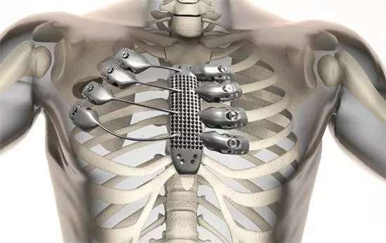 骨科植入物与体外诊断带动医器械市场发展